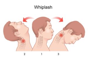 Chiropractor for Whiplash in Springfield, Illinois